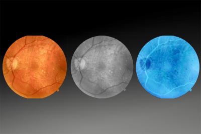 Optovue SOLIX